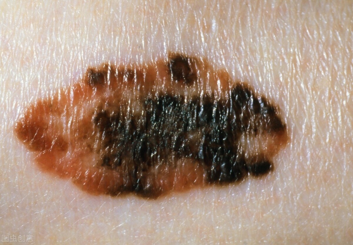 痣变大会是癌变吗,痣变大就是癌变了吗