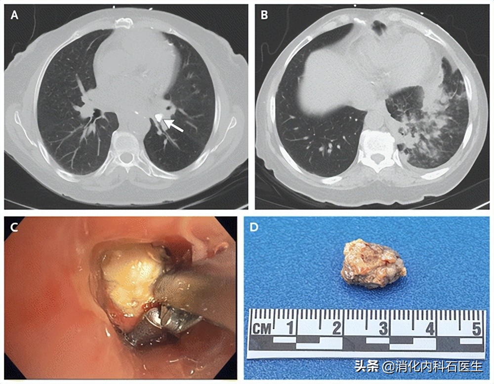 咳血误诊肺癌,男子肺癌被误诊为肺结核