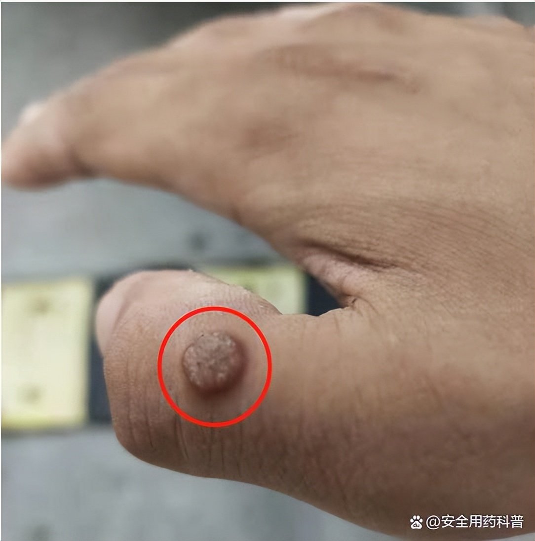 身上的四种疣,身上有很多种疣怎么治疗