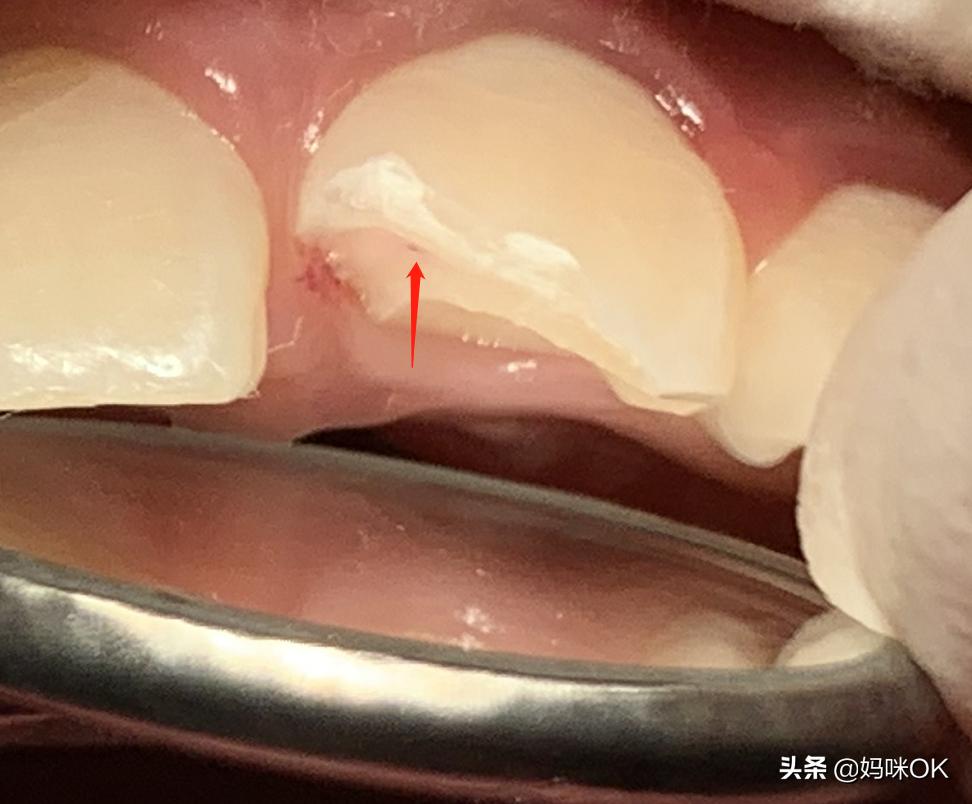 18岁前不能再用门牙吃东西！儿子的这一跤摔得有点惨痛