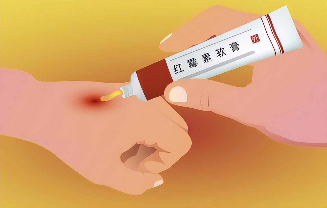 什么药膏去老人斑最有效,红霉素软膏能祛老人斑吗