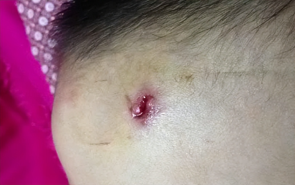 小孩被咬破皮为什么打破伤风针,儿童被大人咬伤要打破伤风针吗