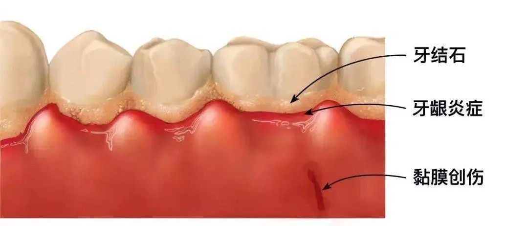 牙龈肿小孩一哭牙龈出血怎么处理,牙龈老是出血用什么老偏方