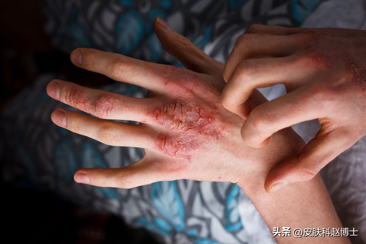 手部角化性湿疹无法痊愈,手部湿疹和汗疱疹的区别