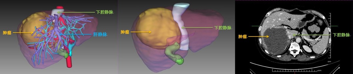 哈医大一院肝脏外科微创切除累及下腔静脉15厘米巨大肝血管瘤