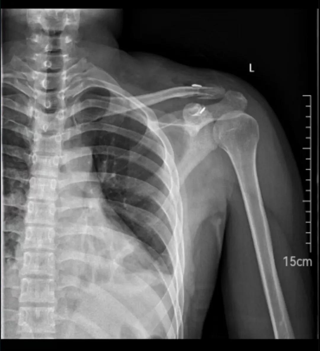 骨折手术细菌感染严重吗,骨折手术感染早期症状