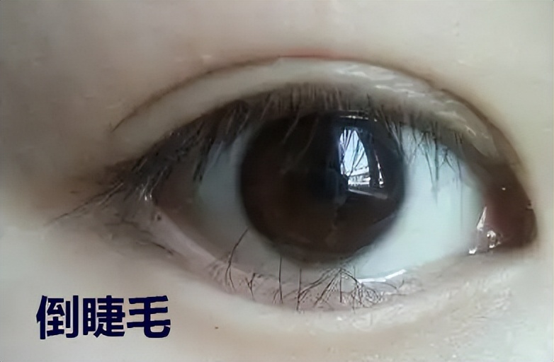 佩戴ok镜老是眨眼怎么办,戴ok镜时一只眼睛有刺痛感