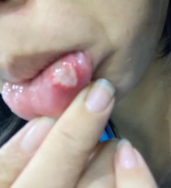 吃完海鲜全身痛,吃完海鲜后腹痛死亡