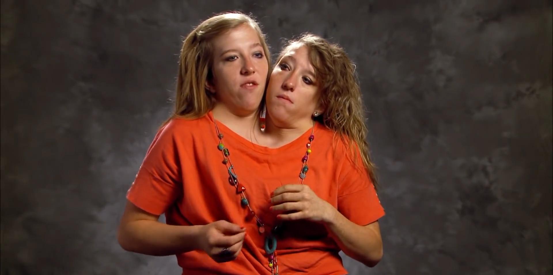 连体人是怎么诞生的,为什么会有雌雄连体人