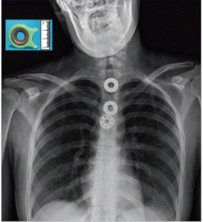 不小心吞进了乐高怎么办,误食乐高