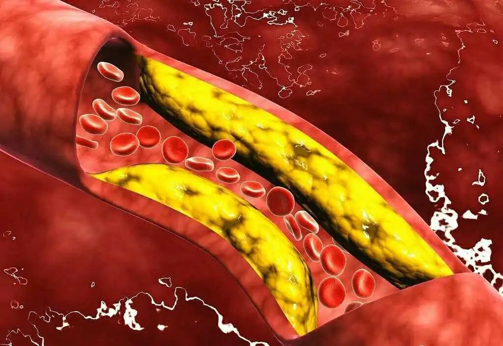 清理血管垃圾打吊瓶,清除血管垃圾输液用什么药