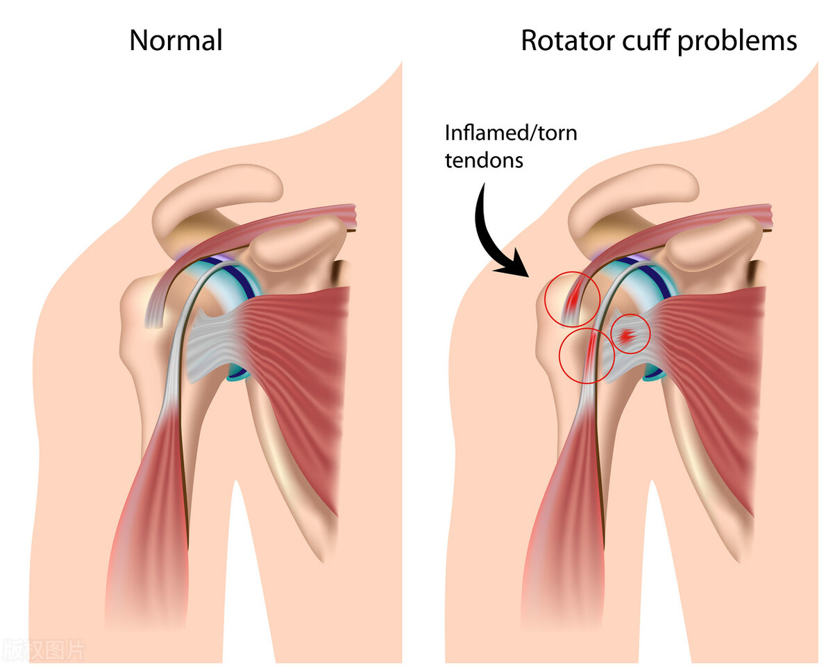 男子打篮球意外受伤,打篮球恶意肘击对方受伤有责任吗