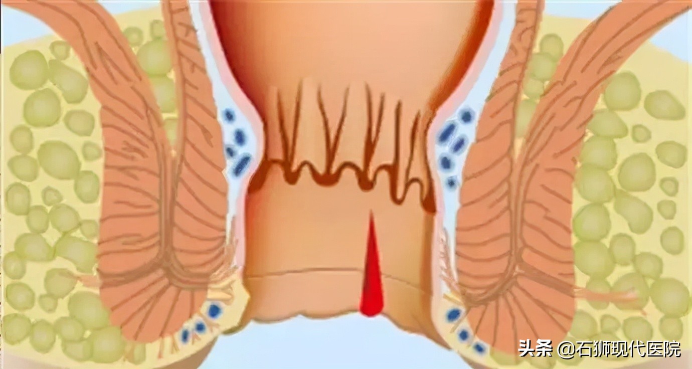 大便时肛门疼痛怎么治疗,大便肛门疼痛用什么药好得快