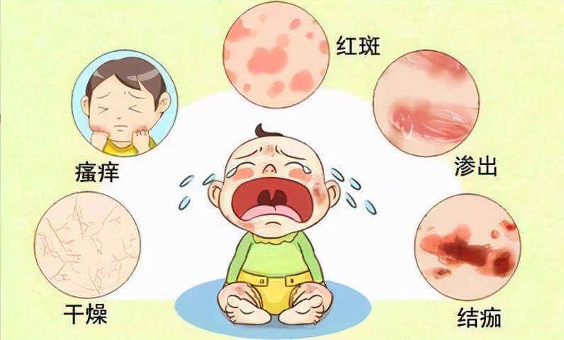 宝宝湿疹反复发作一招解决,宝宝湿疹反复发作如何应对