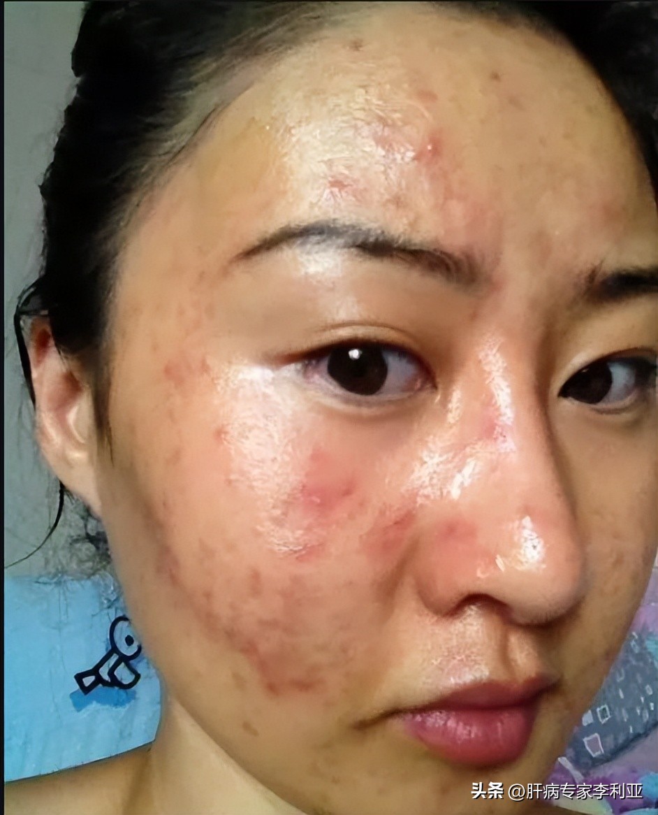 肝癌征兆身上长痘吗,肝癌脸上长痘痘怎么回事