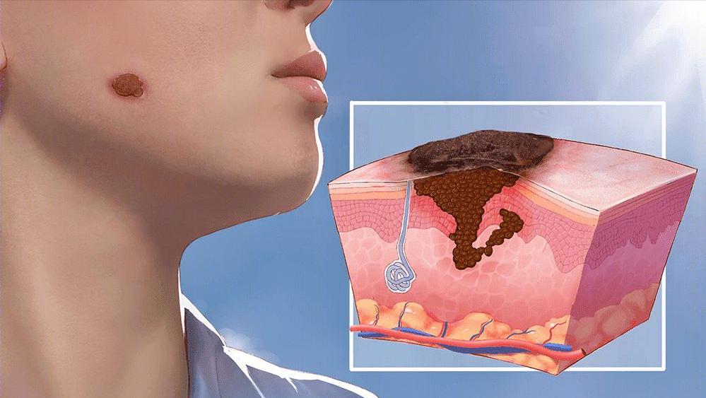 割皮救子父亲康复情况,儿子刚出生为弟弟捐骨髓后续