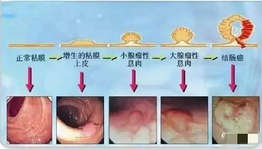 肠长了息肉会有啥症状,肠内为什么容易长息肉