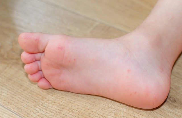 有娃的当心！“疱疹性咽峡炎”最近很猛，传染强，“中招”了超痛