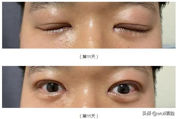 男生割双眼皮的意思,男生眼睛小割双眼皮会好看吗