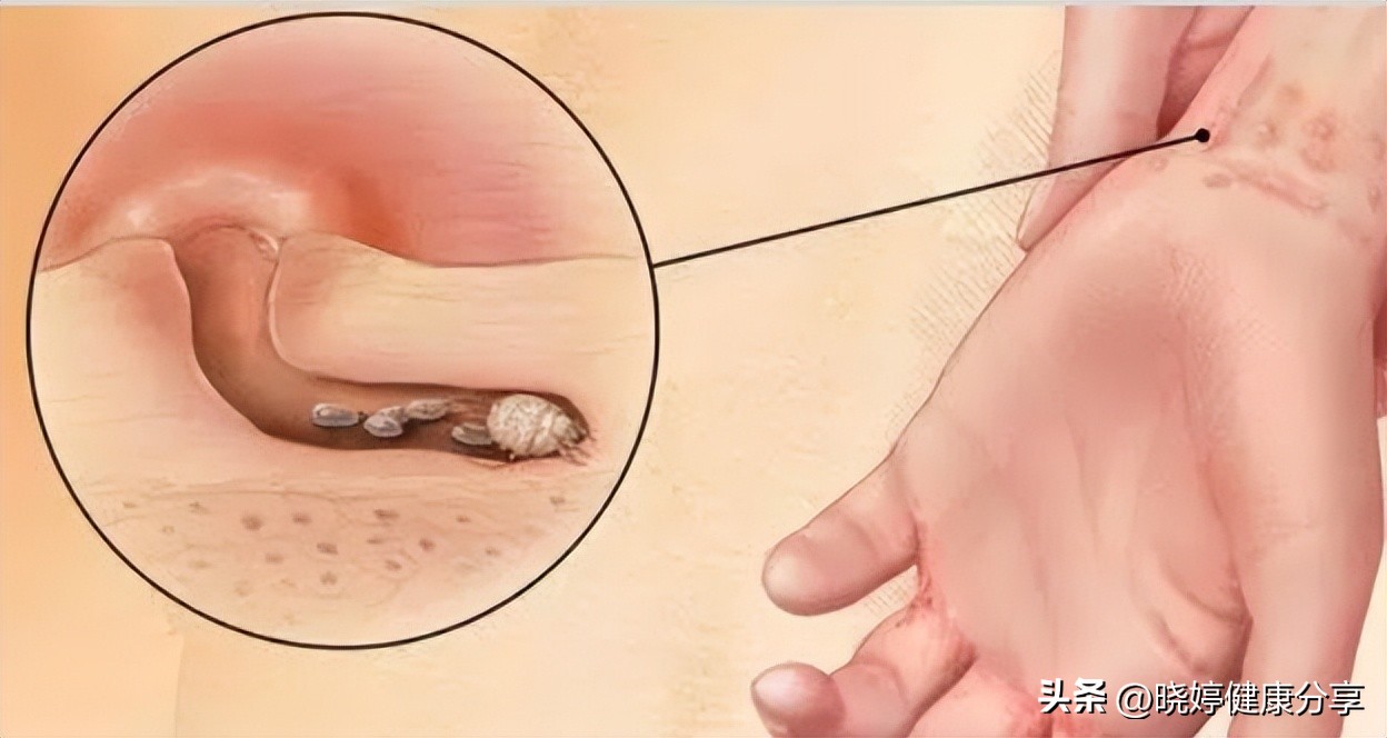 如何确诊疥疮,治疗疥疮怎么判断疥虫死完了