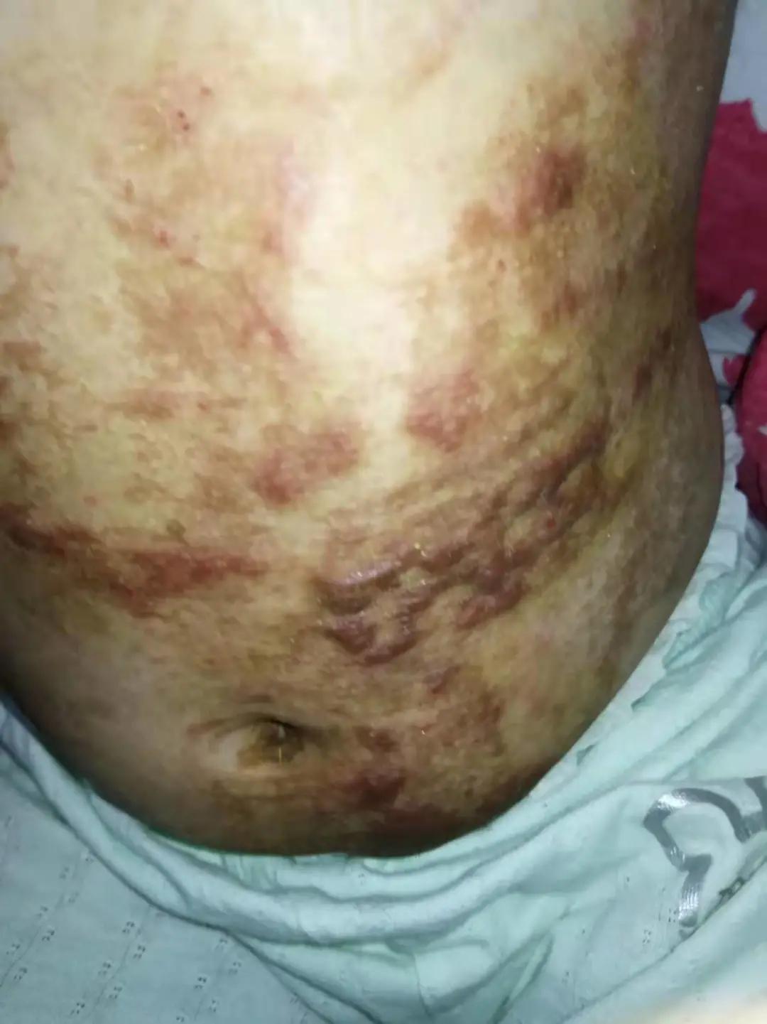 “我女儿3岁，今年要上幼儿园，被开水烫了一身，全家欠一屁股债”