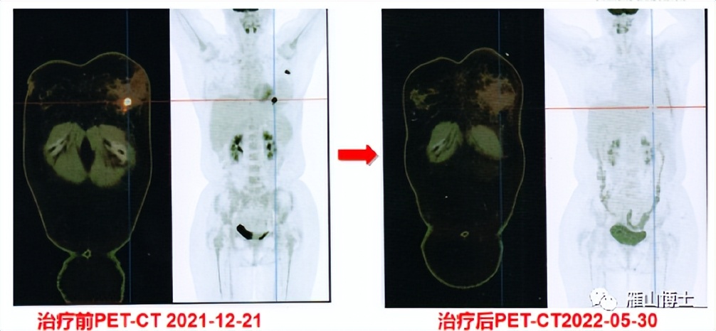 乳腺癌发现得早需要切除乳房吗,面对乳腺癌的正确方法