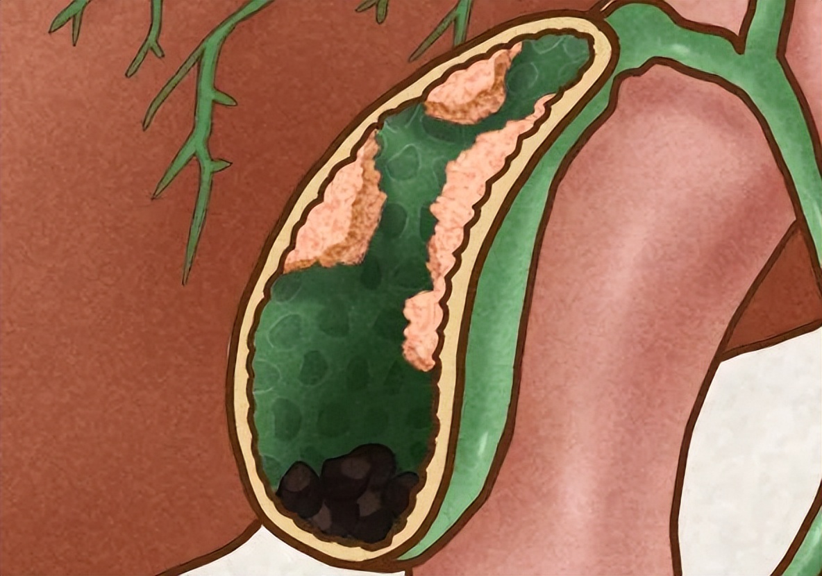 息肉到结肠癌需要多久,息肉到胃癌要多久
