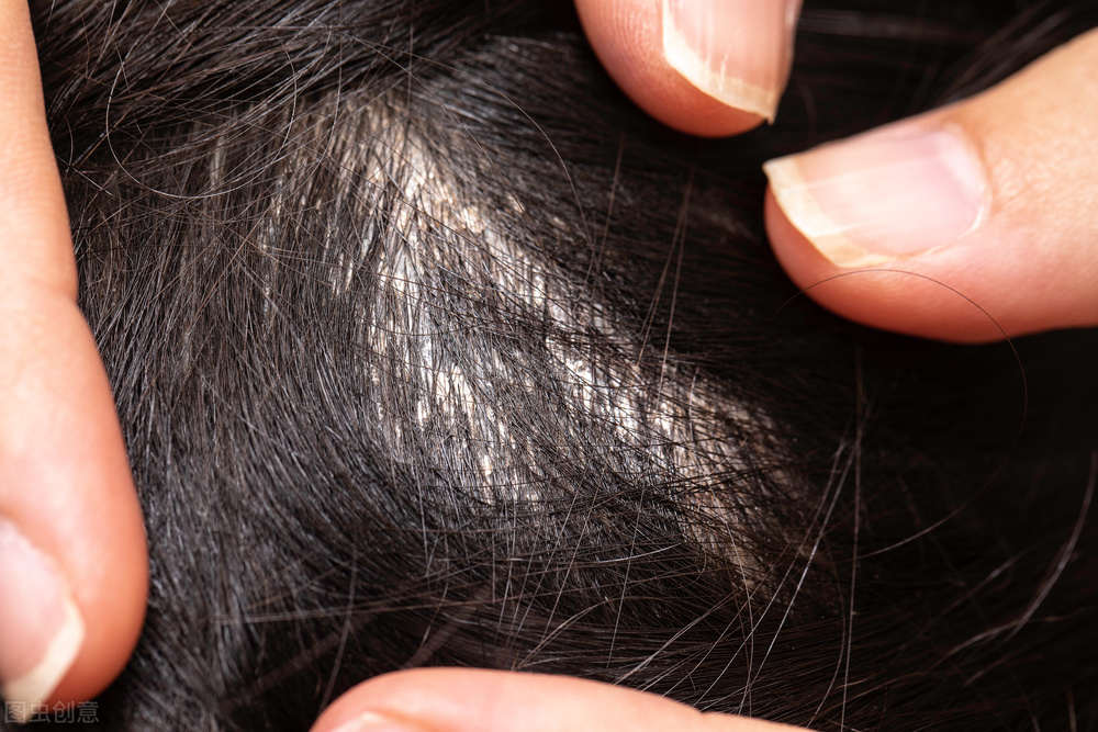 阴虱是什么造成的,阴虱是什么原因造成的呢