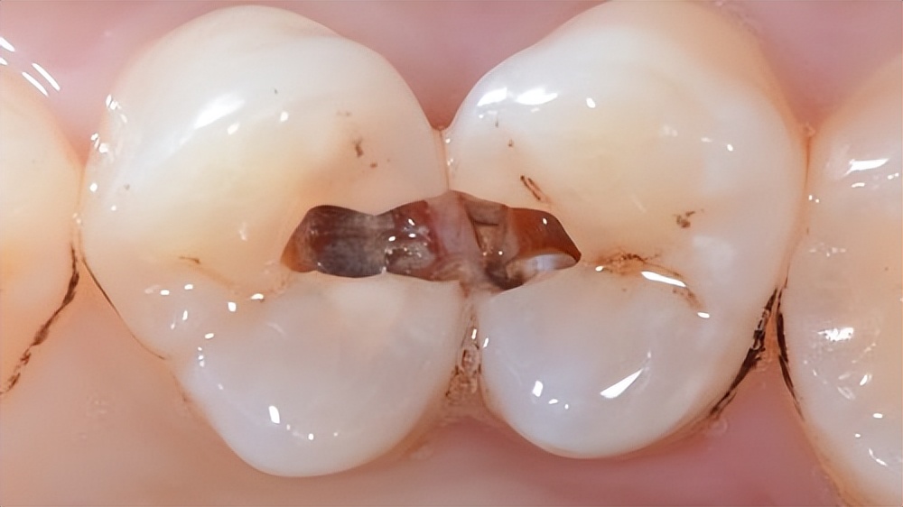 掉牙的人的寿命,小孩掉牙晚和寿命有关系吗