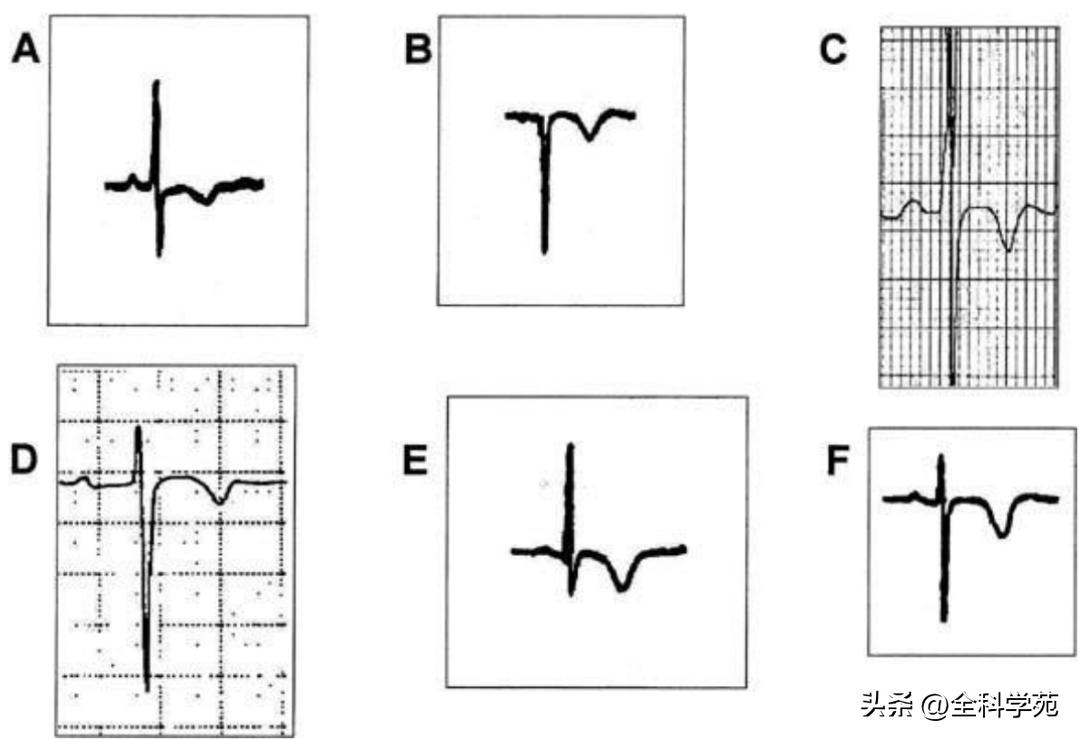 t波倒置三种常见原因,t波低平倒置有事吗