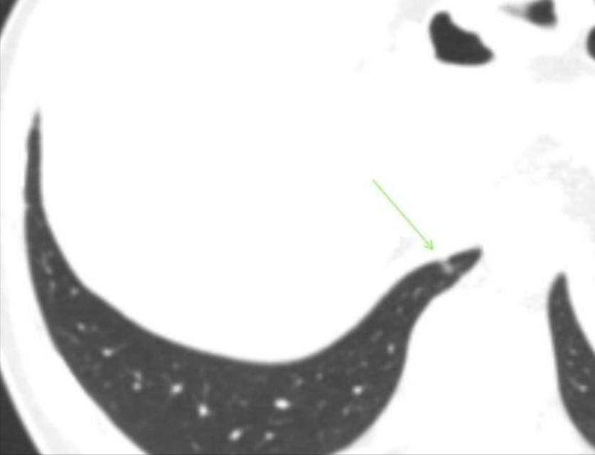 *疆新**28岁结友遇8mm混磨要手术治疗？精准诊断判定是炎症一定可消