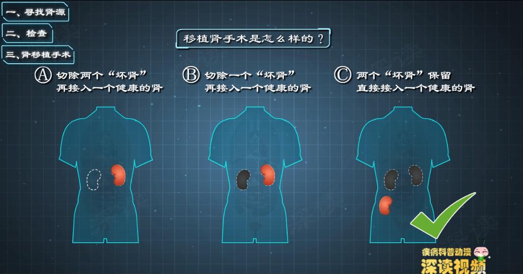 尿毒症配型后是否在医院等候肾源,尿毒症怎么申请国家免费肾移植