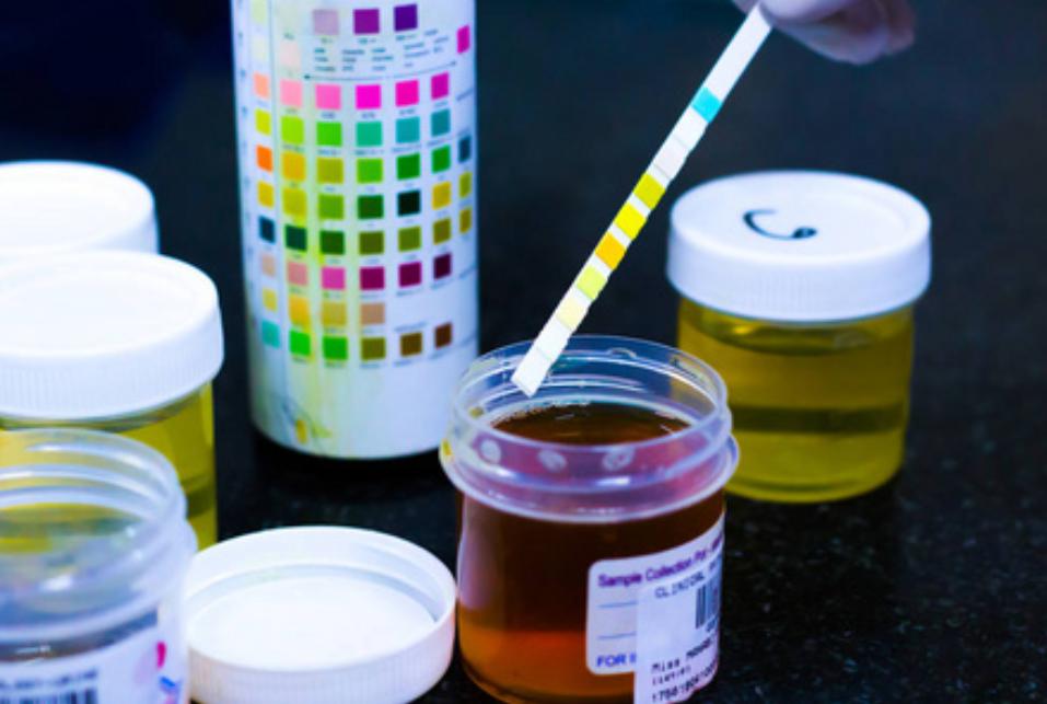 一分钟看懂尿常规化验单最全版,怎样看懂尿常规检查报告单