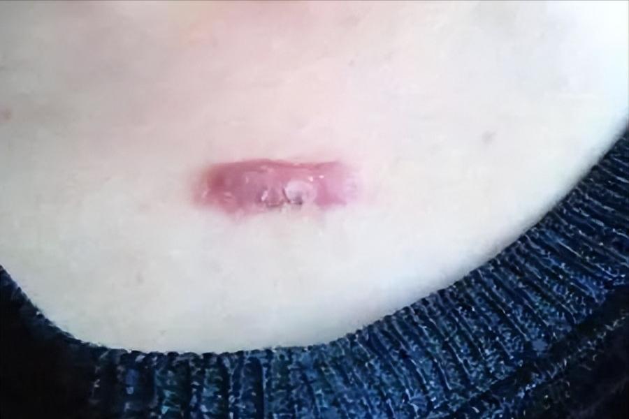 疤痕处痒怎么解决,冬天皮肤干燥起疤痕