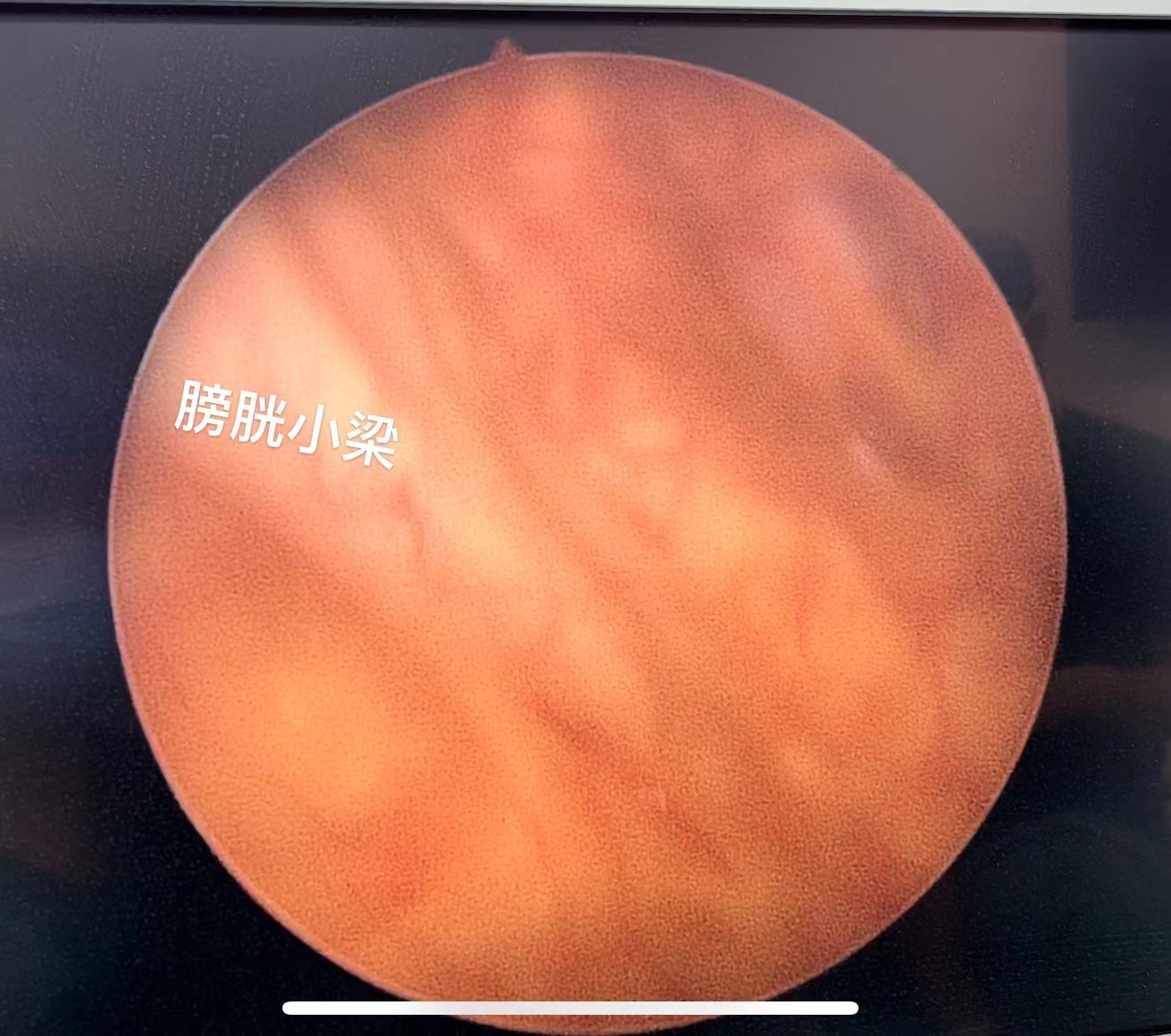 前列腺增生最终会怎么样？会血液透析吗？往往是自己拖出来的