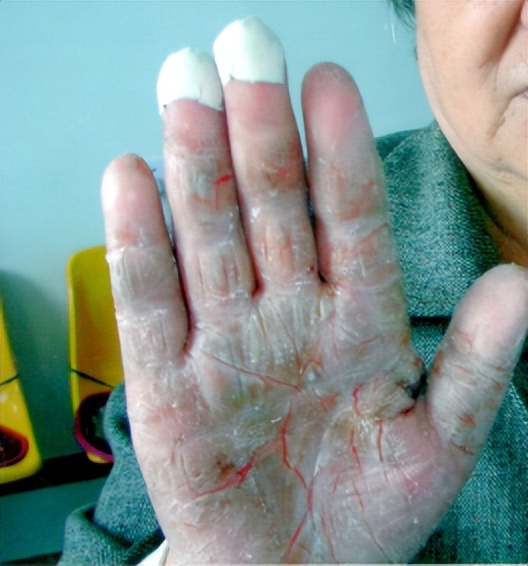 手癣为什么叫鹅掌,手癣鹅掌风