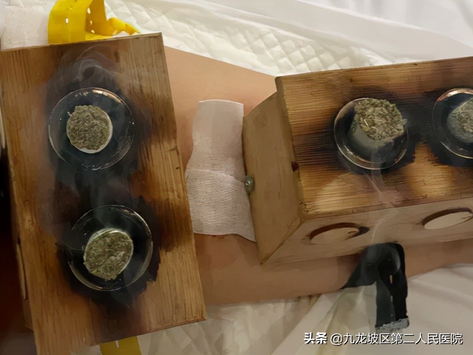 58岁阿姨臀部长疱疹，医生用火针放血、隔物灸疗居然治好