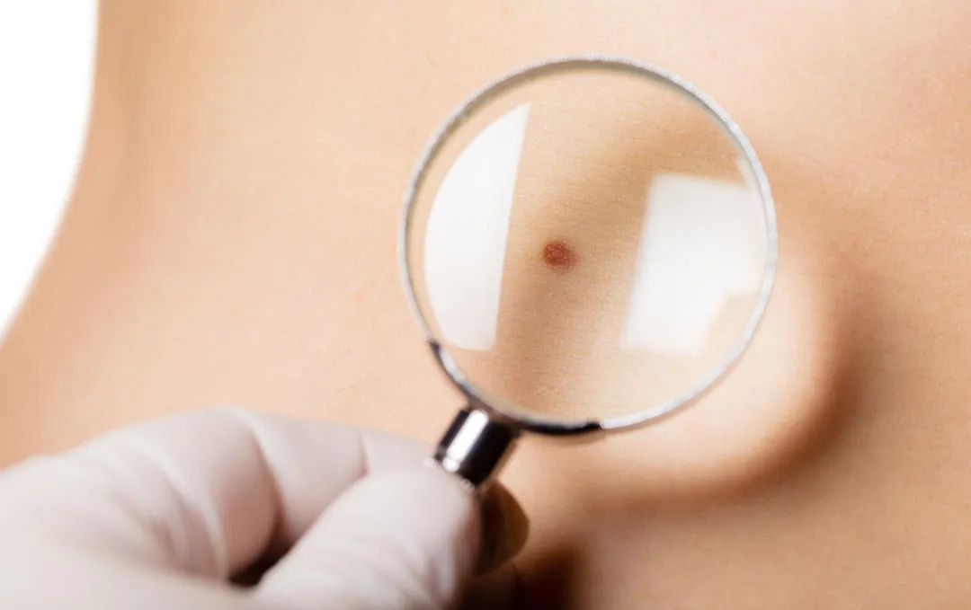 如何判断新长的痣是不是黑色素瘤,正常痣和黑色素痣图片对比说明