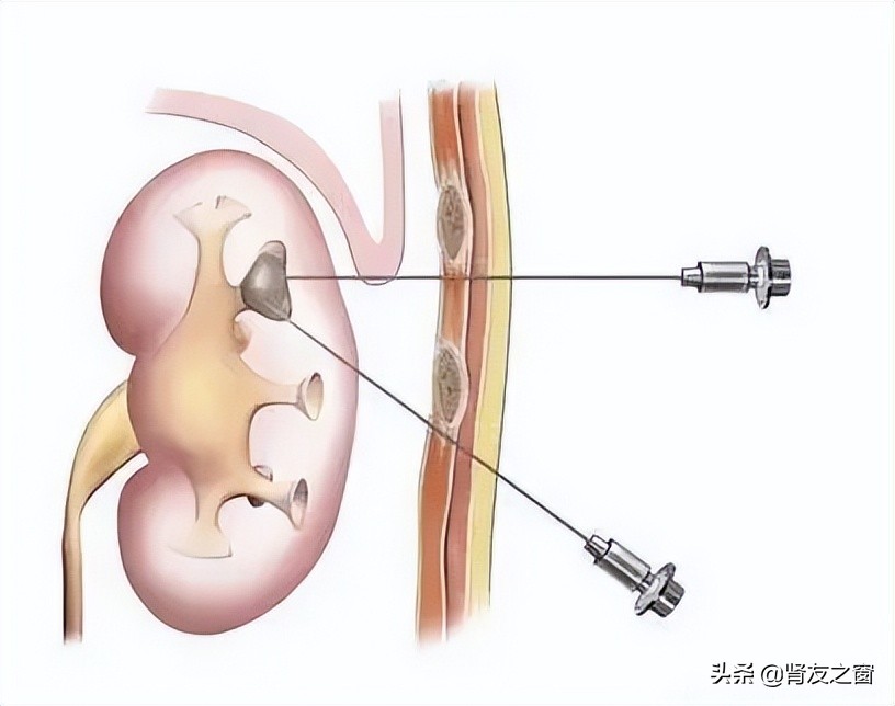 肾活检后，可能会出现哪些问题？详细了解一下