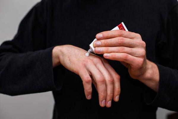 什么原因会引起头发毛囊炎,毛囊炎为什么如此反复难治