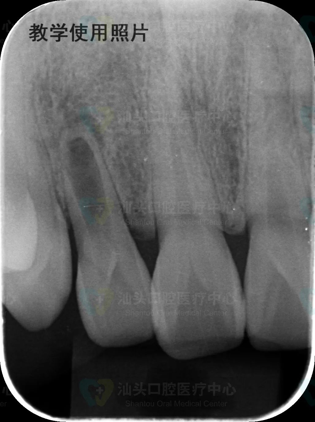 牙齿被牙龈吸收了怎么办,牙齿被吸收一半会有什么反应