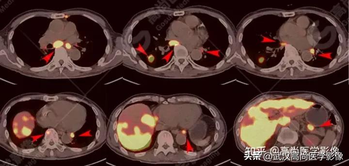 10毫米的肺结节恶性死亡率有多大,1厘米多的肺结节良性可能性多大