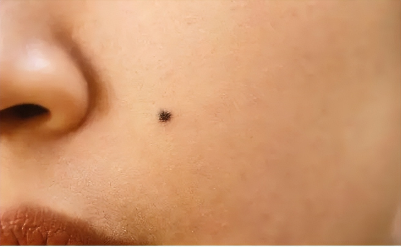 黑痣发生这些变化时要警惕,医生长在摩擦部位的黑痣要当心