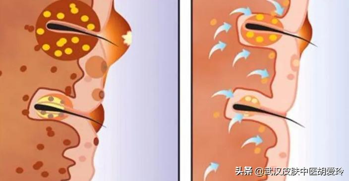 头上长有脓的痘痘怎么回事,脓包型痘痘里的脓怎么处理