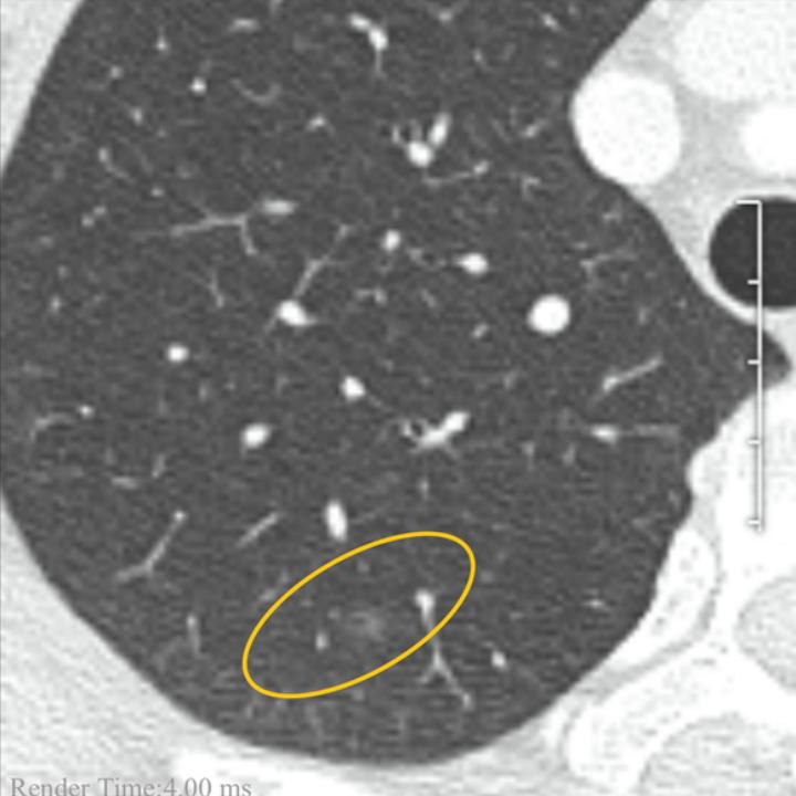 宫颈癌术后肺磨玻璃结节,宫颈癌或者癌前病变