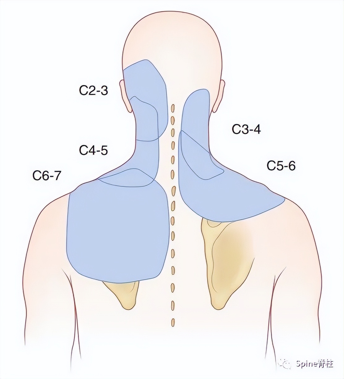脊柱的神经支配,脊柱神经引起手臂疼痛