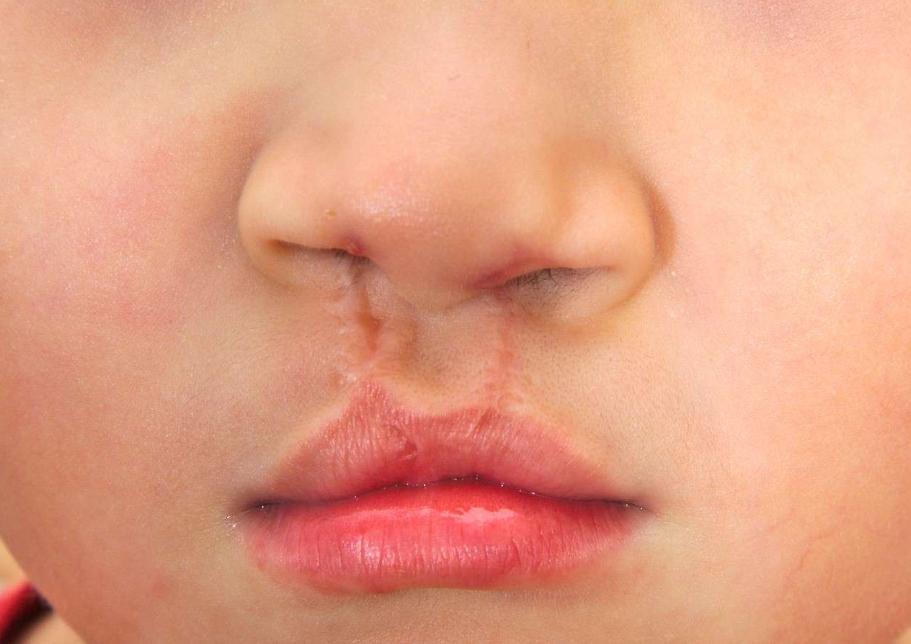 婴儿唇腭裂怎么护理,唇腭裂麻醉