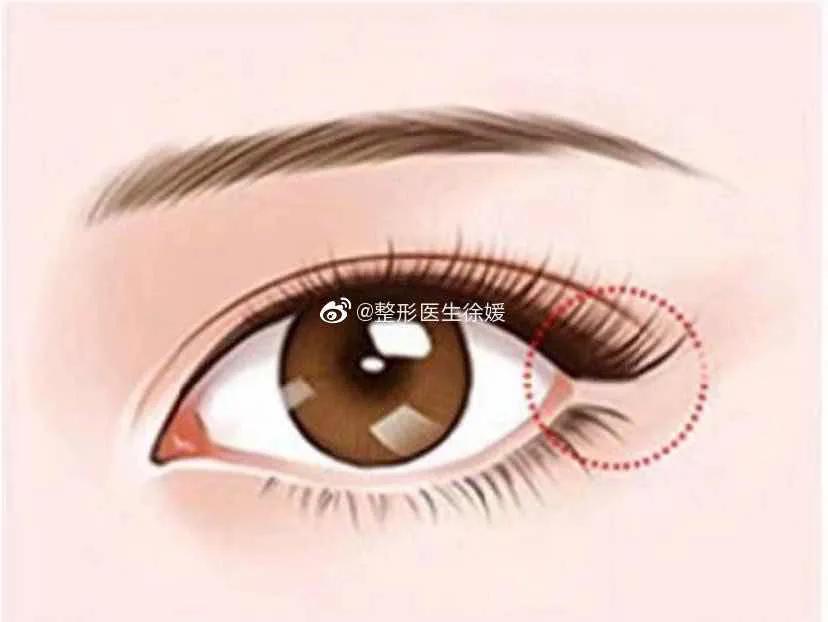 外眼角手术前后对比,做外眼角和不做外眼角的差别