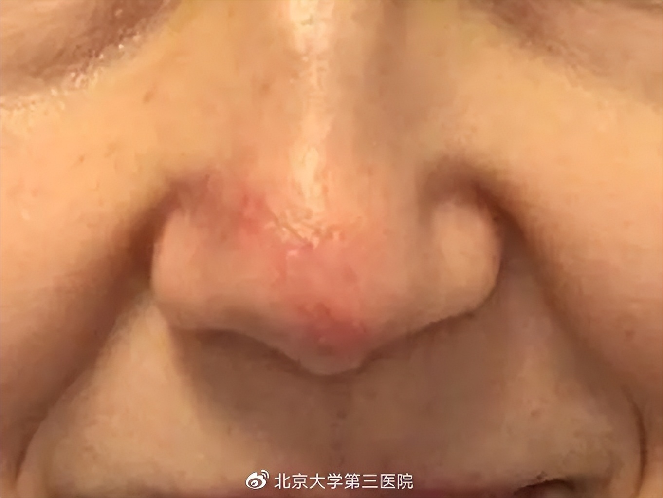 意外留疤怎么安慰,眉尾意外受伤留疤好不好