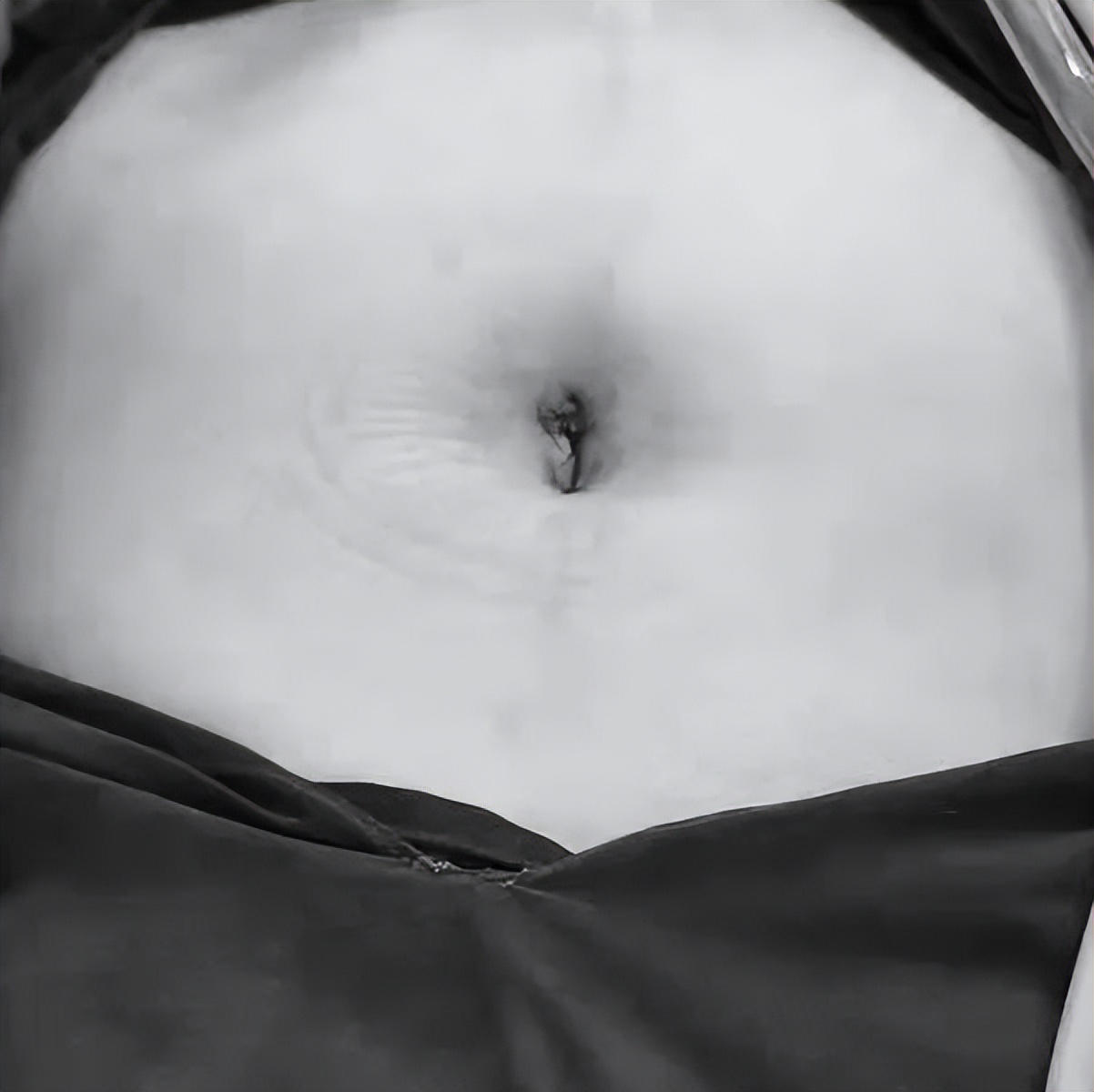 卵巢囊肿微创手术后能清理干净吗,腹腔镜下卵巢囊肿切除术的步骤